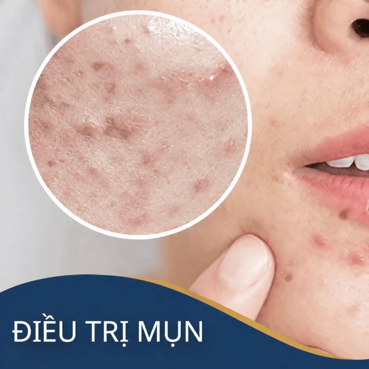 Trị mụn