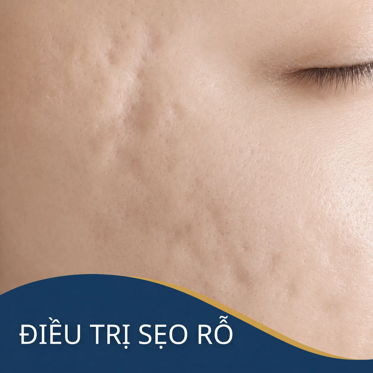 Trị sẹo mụn