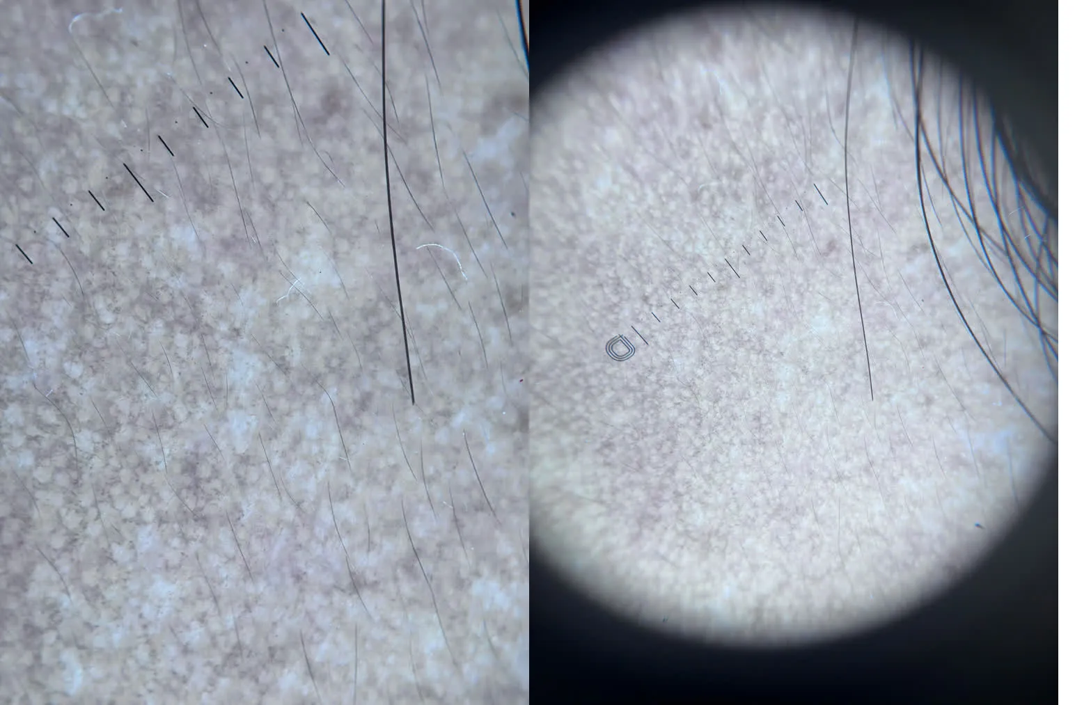 Hình ảnh soi da dermoscopy ca ochronosis ngoại sinh do kem làm trắng: cấu trúc sắc tố xanh xám và nền tăng sắc tố nâu xám