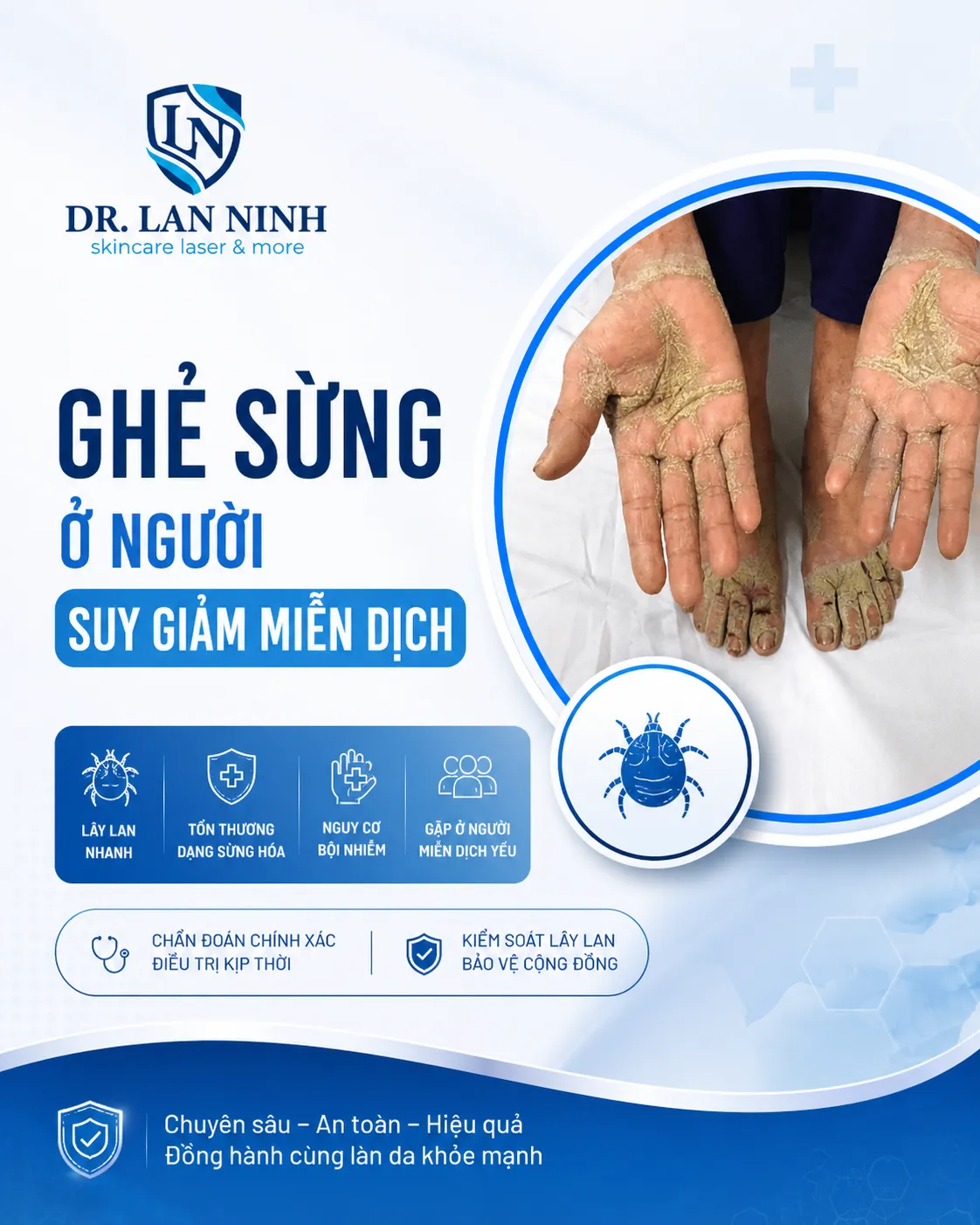 Ghẻ sừng ở người suy giảm miễn dịch: bệnh không nên xem như ghẻ thông thường