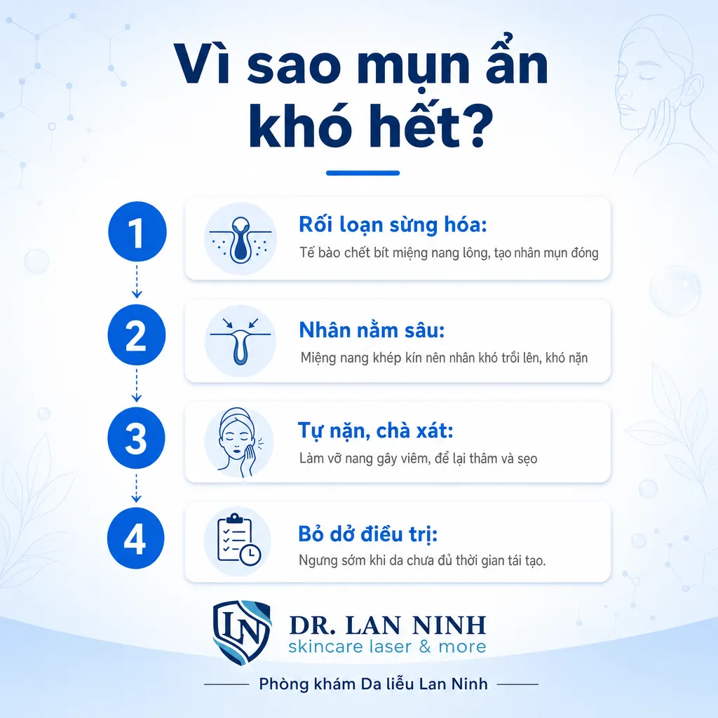 Infographic vì sao mụn ẩn dưới da khó hết: rối loạn sừng hóa, nhân mụn đóng nằm sâu, tự nặn và bỏ dở điều trị