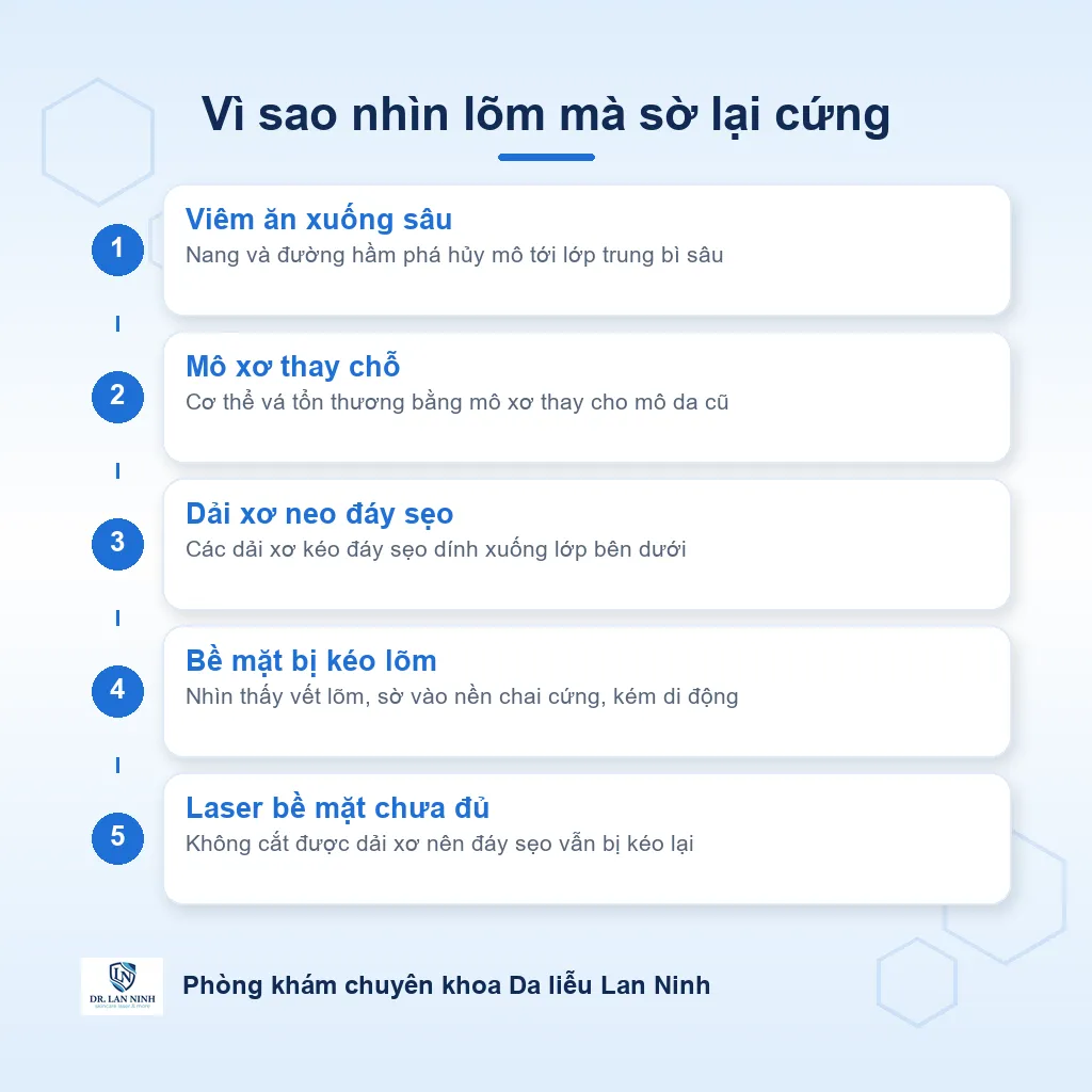 Sơ đồ vì sao sẹo sau mụn mạch lươn nhìn lõm mà sờ lại cứng do dải xơ neo đáy sẹo