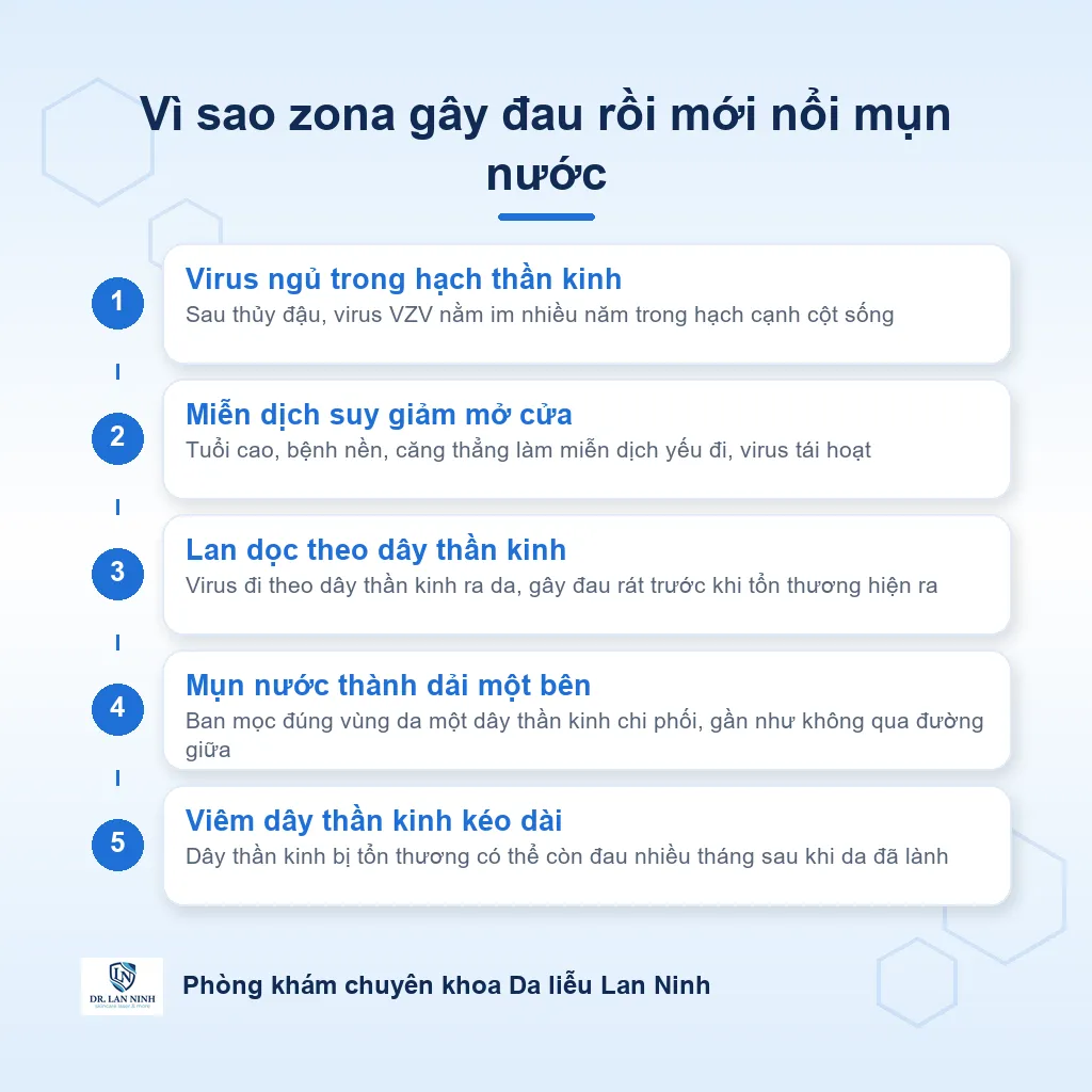 Sơ đồ cơ chế zona thần kinh: virus thủy đậu ngủ trong hạch thần kinh tái hoạt, lan theo dây thần kinh ra da thành dải một bên