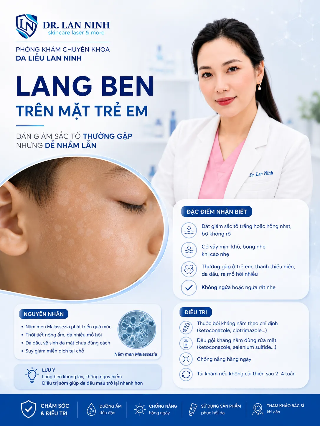 Đồ họa của Phòng khám chuyên khoa Da liễu Lan Ninh về lang ben trên mặt trẻ em: ảnh cận cảnh nhiều dát giảm sắc tố nhỏ ở trán và vùng thái dương, kèm đặc điểm nhận biết, nguyên nhân và hướng điều trị.