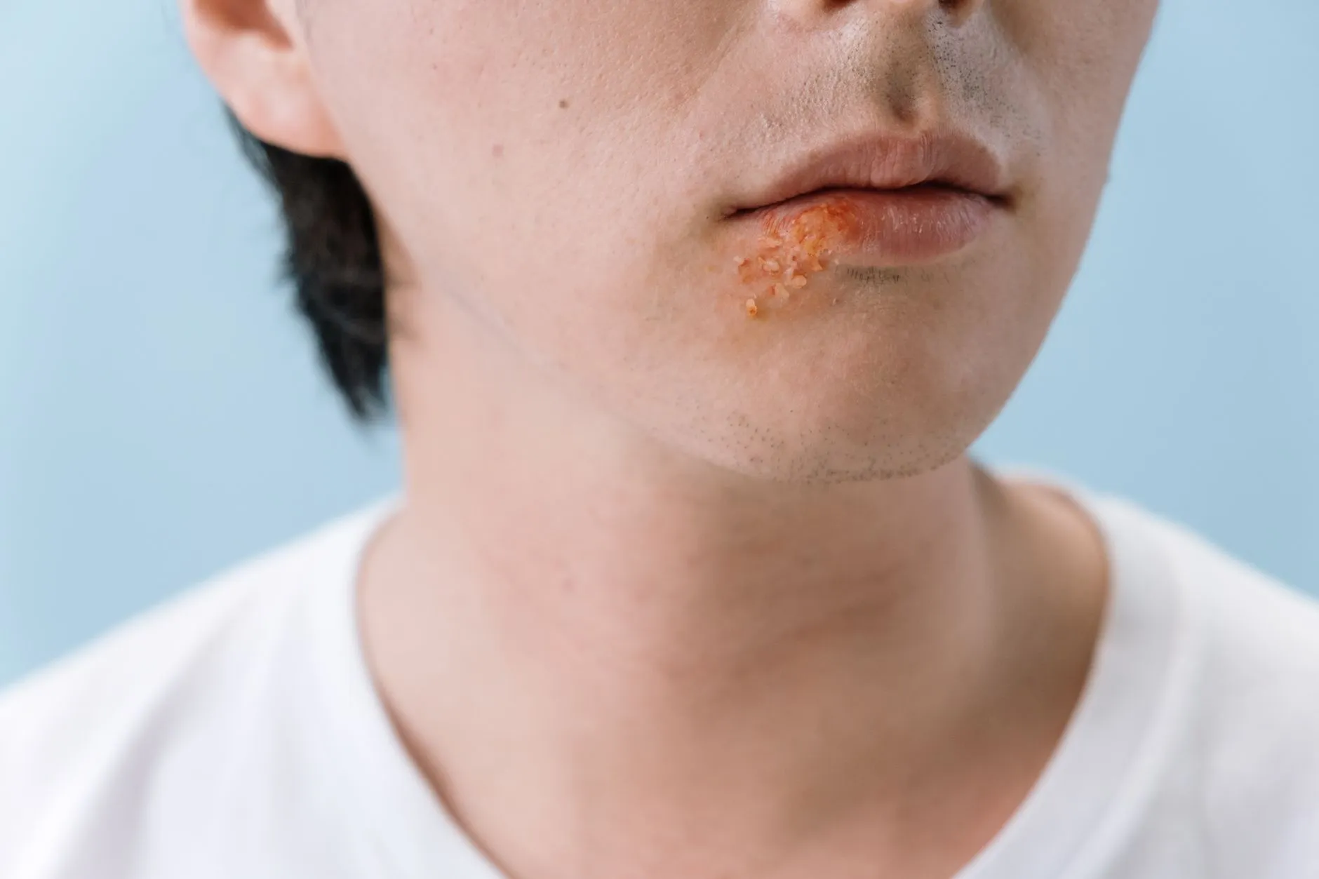 Cận cảnh khóe môi một người có chùm mụn nước nhỏ đang rộp lên.