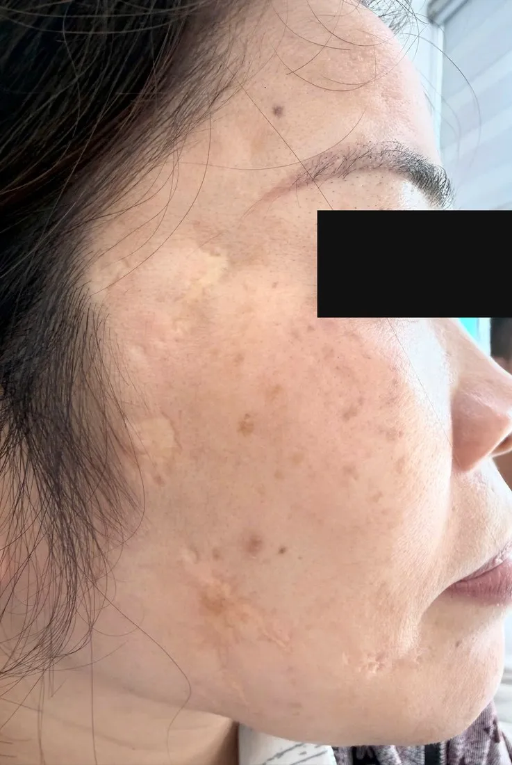 Ảnh lâm sàng vùng má và thái dương: mảng sẹo teo lõm sau mụn mạch lươn xen vệt sẹo sáng màu và nhiều dát tăng sắc tố, đã che vùng nhận diện.
