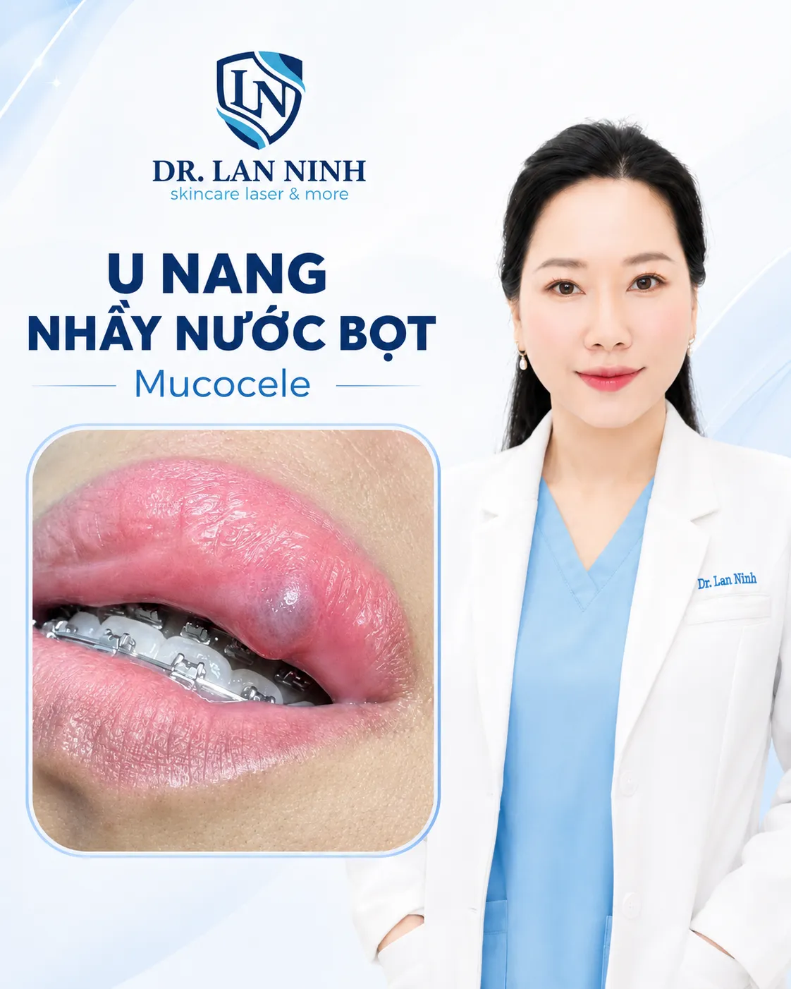 U nang nhầy niêm mạc môi dưới ở người đang niềng răng: khối phồng tròn mặt bóng nổi trên niêm mạc, ngay vị trí tiếp xúc với mắc cài.