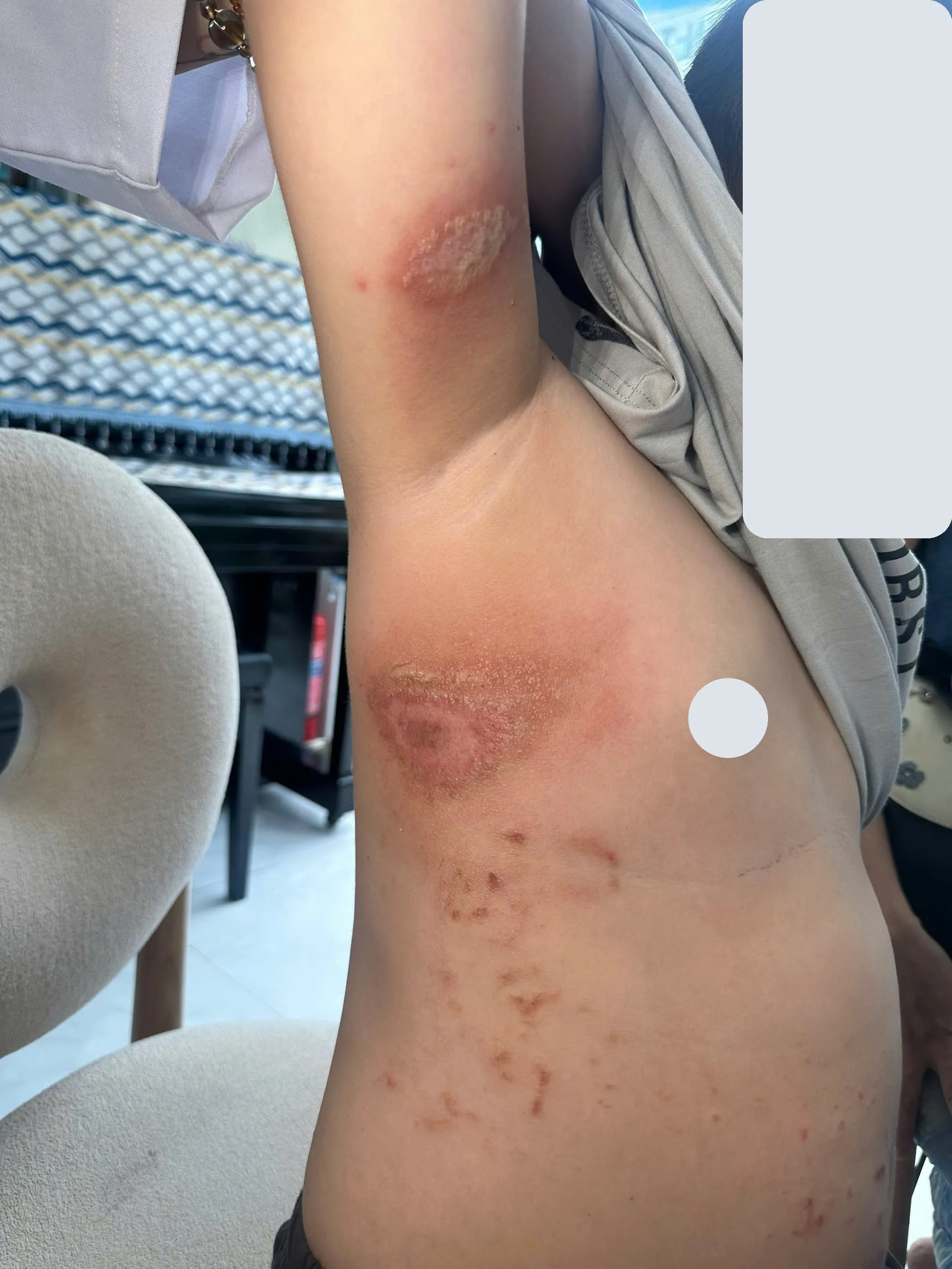 Tổn thương viêm da tiếp xúc do kiến ba khoang ở trẻ nhỏ: mảng đỏ có vảy ở nách và mạng sườn, tạo cặp tổn thương áp mặt qua nếp nách.