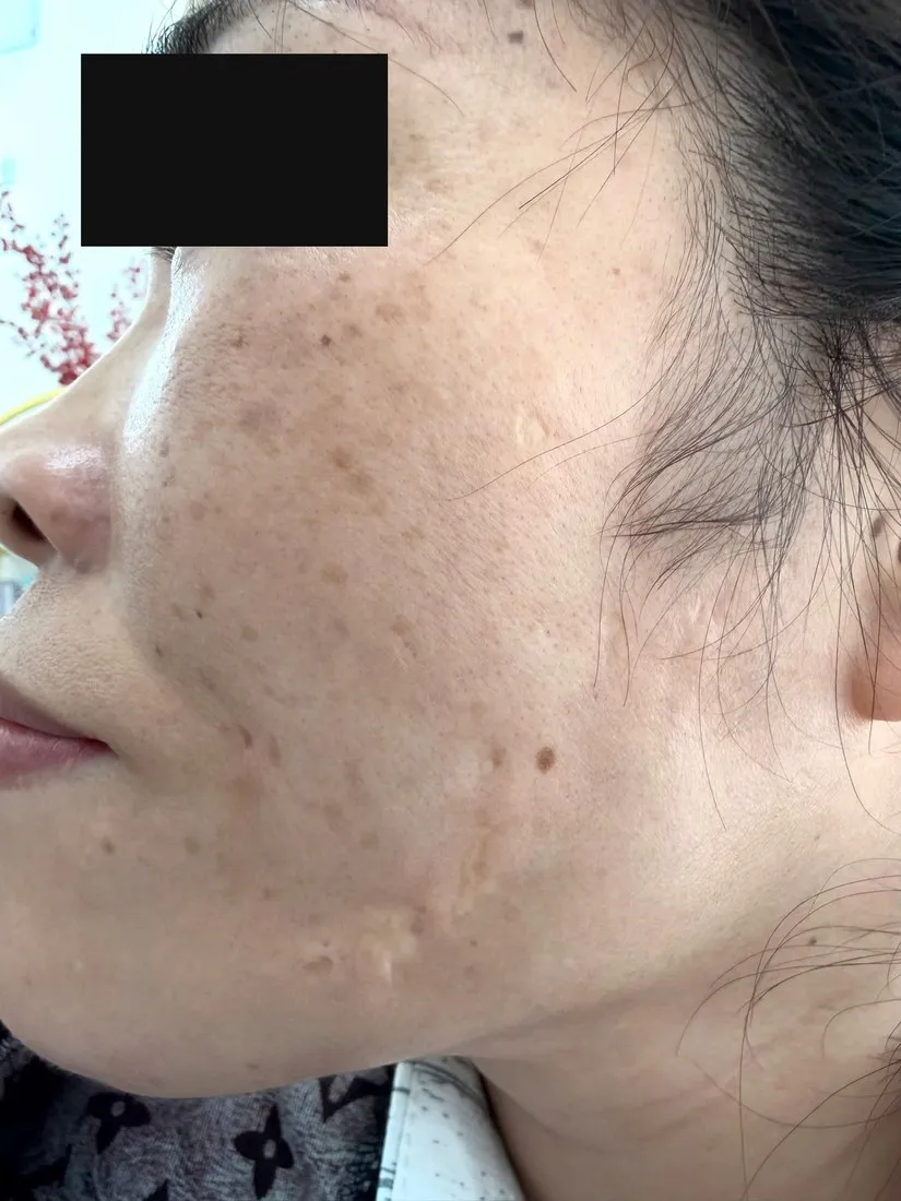 Ảnh lâm sàng vùng má nhìn nghiêng: các vết sẹo lõm và dải sẹo xơ sau mụn mạch lươn cùng dát nâu rải rác, đã che vùng nhận diện.