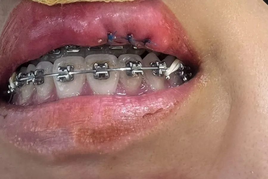 Niêm mạc môi dưới sau khi bóc tách trọn u nang nhầy và khâu đóng bằng ba mũi chỉ, thực hiện dưới gây tê tại chỗ.