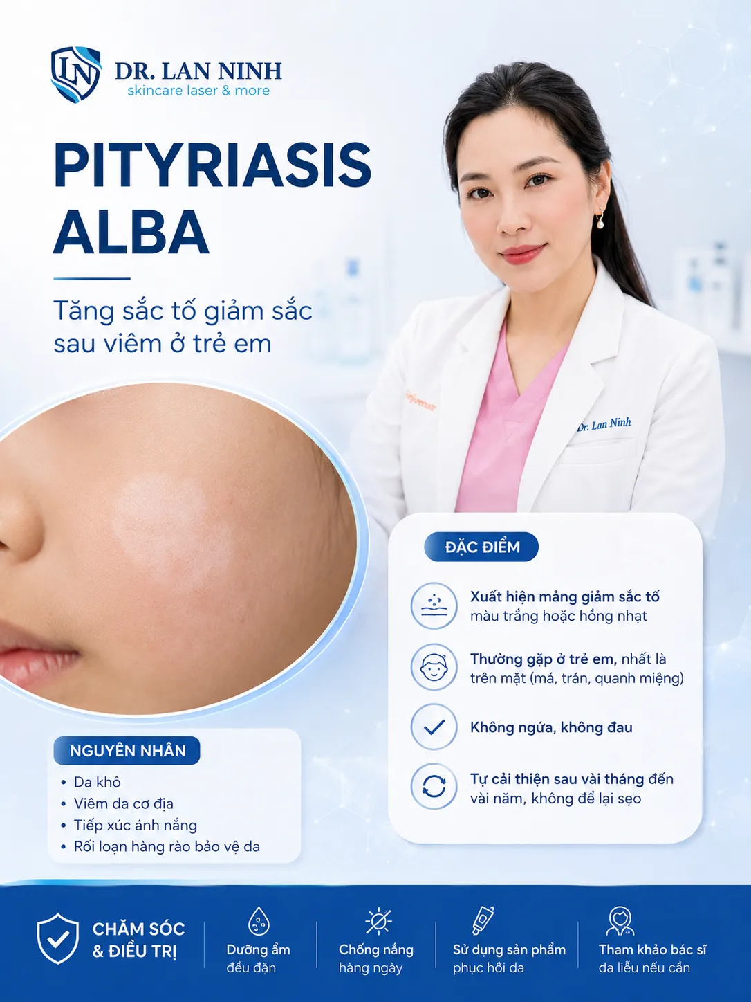 Đồ họa của Phòng khám chuyên khoa Da liễu Lan Ninh về vảy phấn trắng (pityriasis alba) ở trẻ em: ảnh cận cảnh mảng giảm sắc tố khô, bờ mờ trên má trẻ, kèm đặc điểm nhận biết, nguyên nhân và hướng chăm sóc.