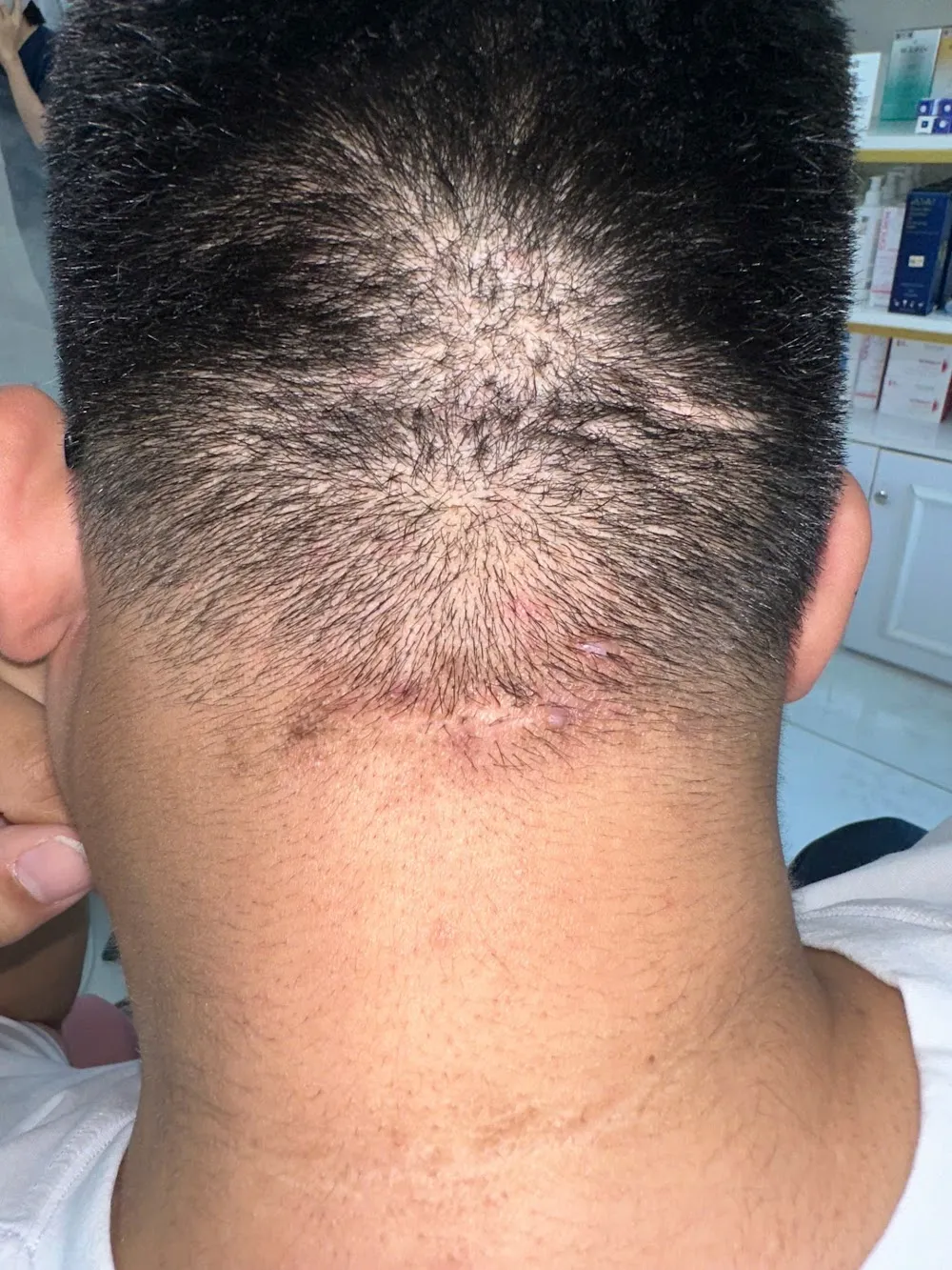 Vùng gáy bệnh nhân acne keloidalis nuchae với các sẩn dọc chân tóc và mảng da thưa tóc ở vùng chẩm dưới