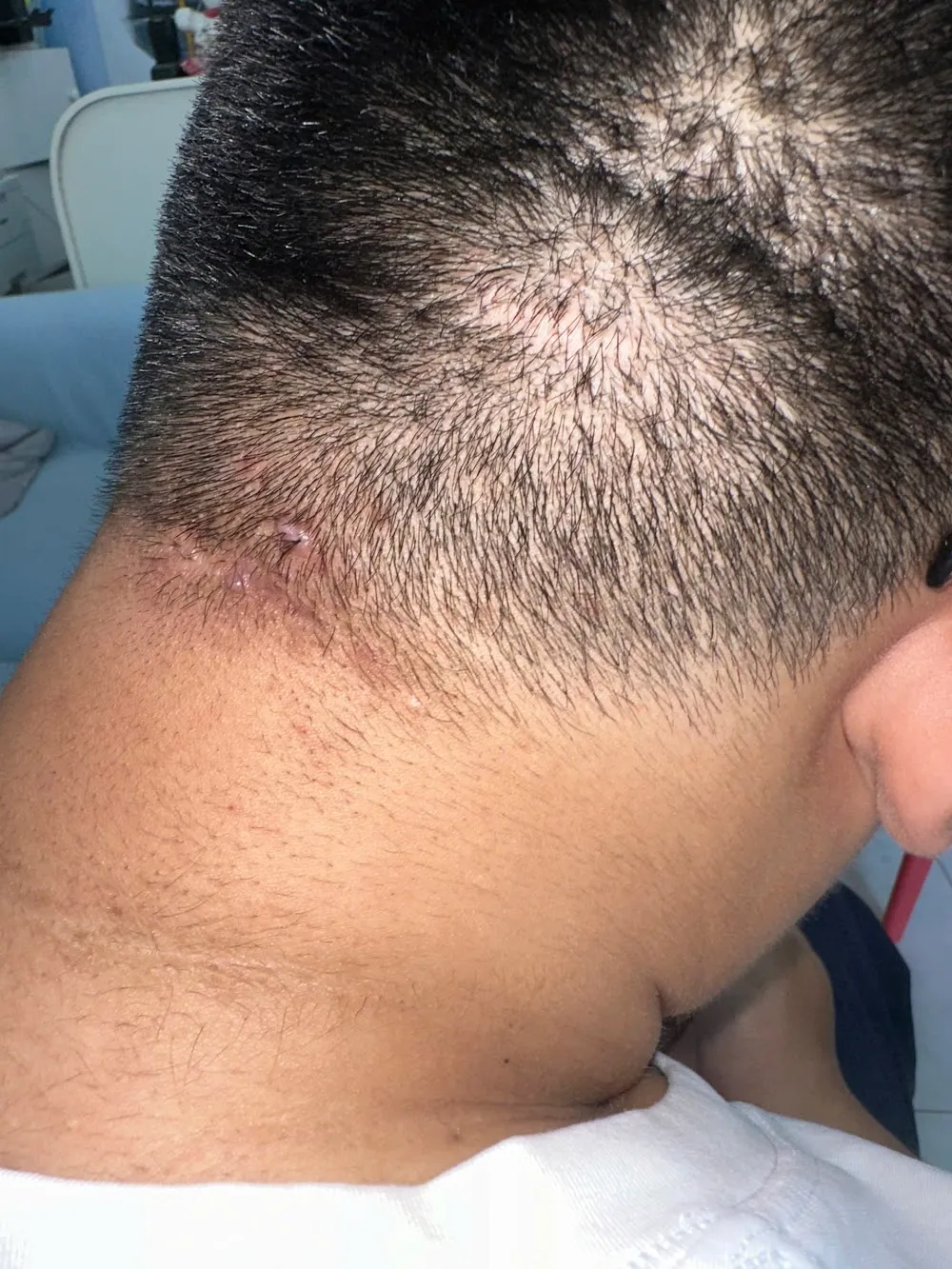 Cận cảnh nghiêng vùng chân tóc gáy với các sẩn cục chắc màu hồng của acne keloidalis nuchae giai đoạn sớm