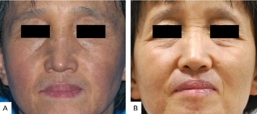Riehl melanosis: dát tăng sắc tố nâu xám ở trán, thái dương và hai bên gò má
