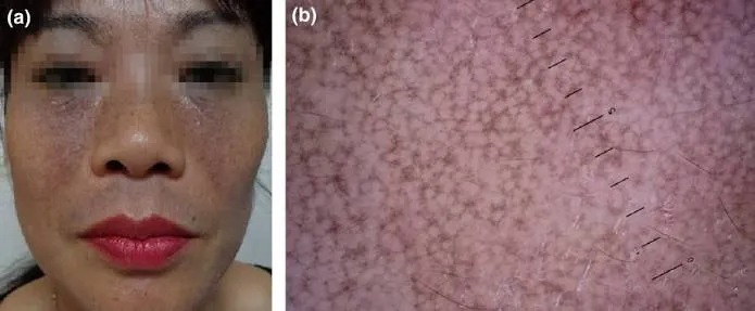 Đối chiếu hình ảnh lâm sàng và soi da dermoscopy của một ca Riehl melanosis
