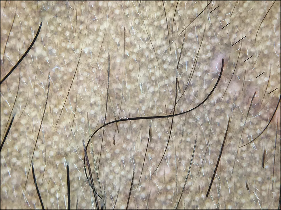 Soi da dermoscopy Riehl melanosis: giả lưới sắc tố với lỗ chân lông sáng màu và chấm xám mịn