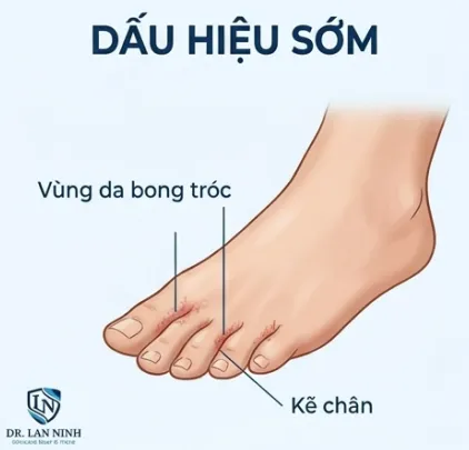 Nấm kẽ chân: nhận biết sớm và tránh lây trong gia đình