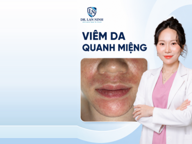 VIÊM DA QUANH MIỆNG: VÌ SAO BÔI CORTICOID CÀNG NẶNG THÊM