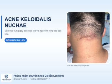 ACNE KELOIDALIS NUCHAE: SẨN CỤC VÙNG GÁY SAU CẠO TÓC