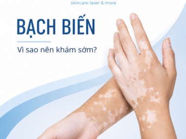 Bạch biến mới xuất hiện: khám sớm tại Bình Dương