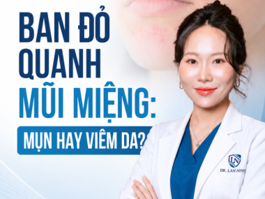 BAN ĐỎ QUANH MŨI MIỆNG: MỤN, ROSACEA HAY VIÊM DA QUANH MIỆNG?
