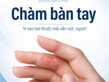 Chàm bàn tay: vì sao bôi thuốc mãi vẫn nứt ngứa?