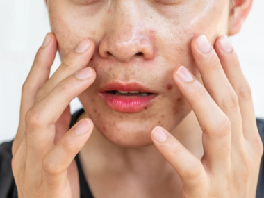 DA DẦU CÓ CẦN DƯỠNG ẨM KHÔNG? MỘT TRONG NHỮNG HIỂU LẦM PHỔ BIẾN NHẤT KHI CHĂM SÓC DA