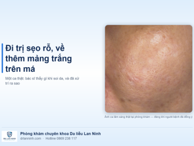 ĐI TRỊ SẸO RỖ, VỀ THÊM MẢNG TRẮNG TRÊN MÁ: MỘT CA THẬT
