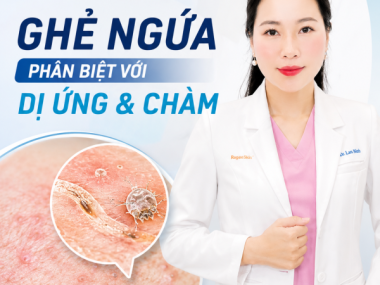 Ghẻ ngứa: dấu hiệu phân biệt với dị ứng và chàm