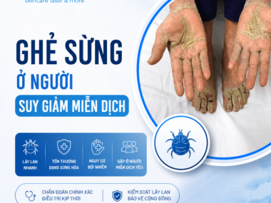 GHẺ SỪNG Ở NGƯỜI SUY GIẢM MIỄN DỊCH