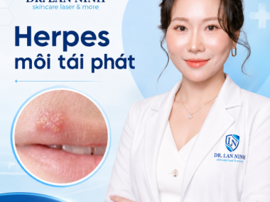 Herpes môi tái phát: khi nào cần thuốc kháng virus?