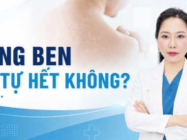 Lang ben có tự hết không? Khi nào cần điều trị đúng cách?
