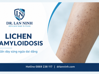 LICHEN AMYLOIDOSIS: NGUYÊN NHÂN, DẤU HIỆU VÀ HƯỚNG ĐIỀU TRỊ