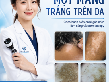 Một mảng trắng trên da: case bạch biến đang hoạt động qua lâm sàng và dermoscopy