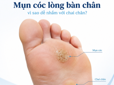 Mụn cóc lòng bàn chân dễ nhầm với chai chân vì sao?