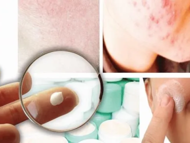 MỤN DO CORTICOID LÀ GÌ?