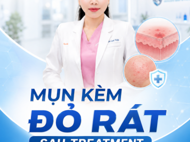 Mụn đỏ rát sau treatment tại Thủ Dầu Một: nên phục hồi hay trị mụn trước?
