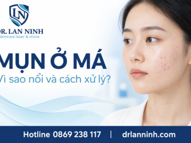 MỤN Ở MÁ: VÌ SAO NỔI VÀ CÁCH XỬ LÝ Ở THỦ DẦU MỘT