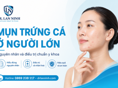 MỤN TRỨNG CÁ Ở NGƯỜI LỚN: NGUYÊN NHÂN VÀ ĐIỀU TRỊ