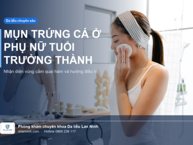 MỤN TRỨNG CÁ Ở PHỤ NỮ TUỔI TRƯỞNG THÀNH: NHẬN DIỆN VÀ ĐIỀU TRỊ
