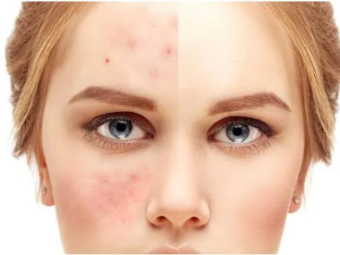 MỤN VIÊM VÀ MỤN KÍCH ỨNG KHÁC NHAU THẾ NÀO?