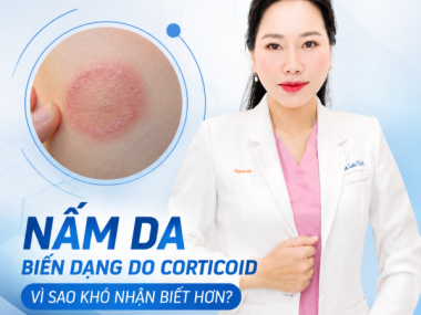 Nấm da bị biến dạng do corticoid: vì sao khó nhận biết hơn?