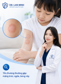 Nấm Da Do Thú Cưng: Trẻ Nổi Mảng Tròn Ngứa Phải Làm Gì?