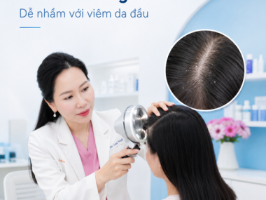 Nấm tóc ở người lớn: dễ nhầm với viêm da đầu | BS Lan Ninh