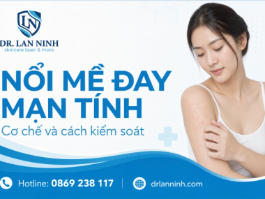 NỔI MỀ ĐAY MẠN TÍNH: CƠ CHẾ VÀ CÁCH KIỂM SOÁT