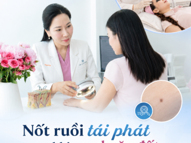 Nốt ruồi tái phát sau khi đốt ở Thủ Dầu Một: vì sao cần khám lại?