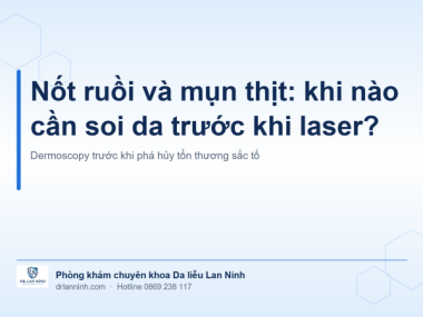 NỐT RUỒI VÀ MỤN THỊT: KHI NÀO CẦN SOI DA TRƯỚC KHI LASER?
