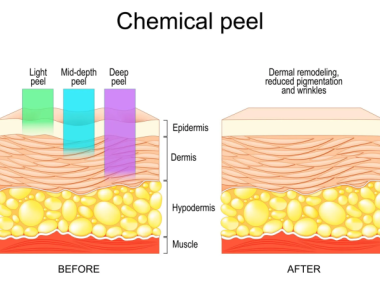 PEEL DA TRỊ MỤN CÓ THẬT SỰ HIỆU QUẢ?