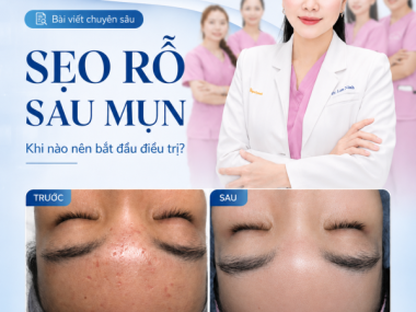 Sẹo rỗ sau mụn: khi nào nên bắt đầu điều trị ở Thủ Dầu Một?