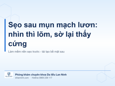 SẸO SAU MỤN MẠCH LƯƠN: NHÌN THÌ LÕM, SỜ LẠI THẤY CỨNG